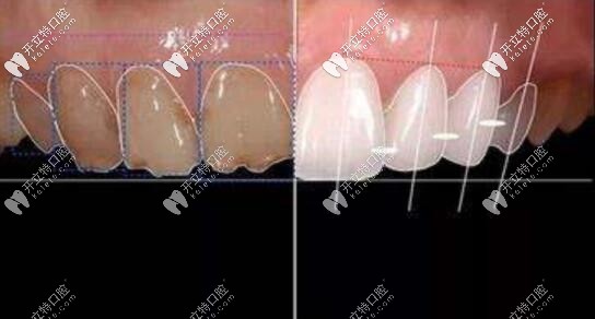 瓷貼面設(shè)計(jì)