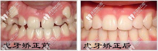 給深圳的菇涼們,暢談我戴時代天使隱形牙套矯正虎牙的感受