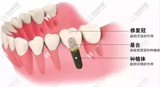 種植牙的示意圖