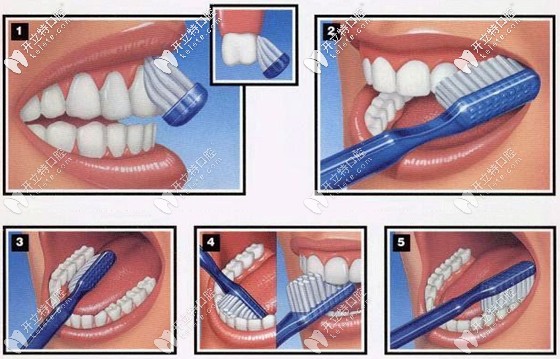 <!--<i data=20240703-sp></i>-->醫(yī)生講解巴氏刷牙法