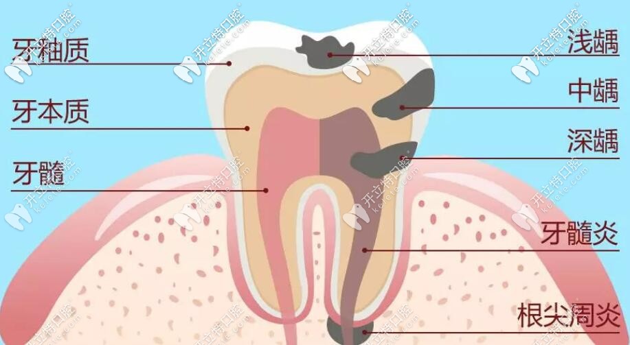 齲齒的發(fā)展過程