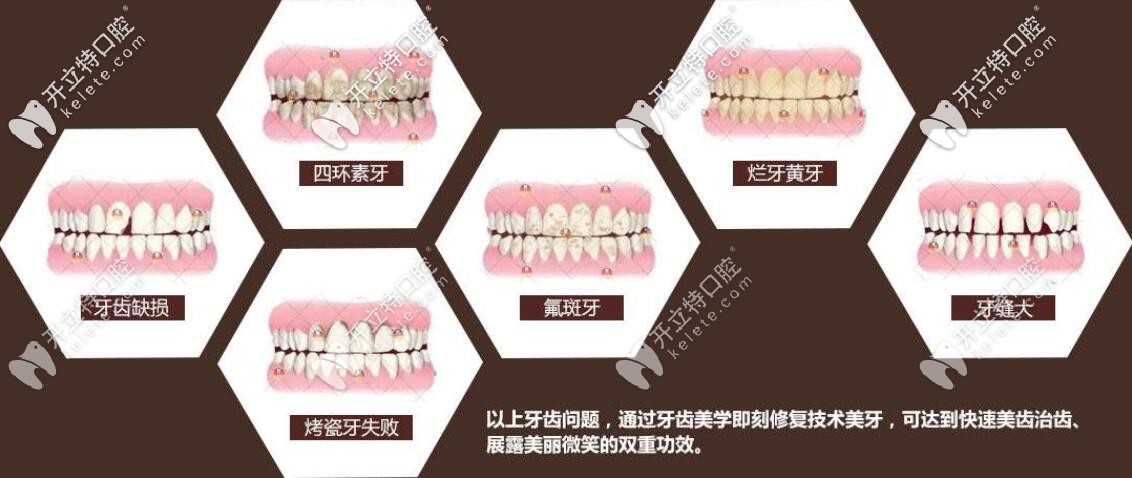 牙齒美學(xué)修復(fù)適應(yīng)癥