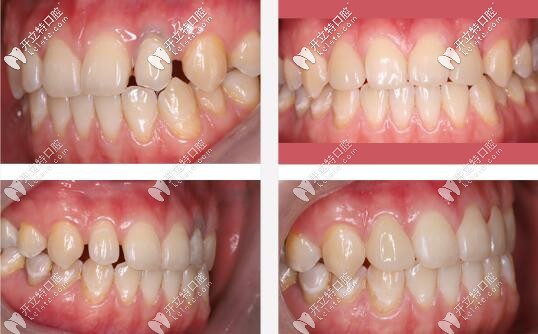 陳梅訊醫(yī)生牙齒美學(xué)修復(fù)案例