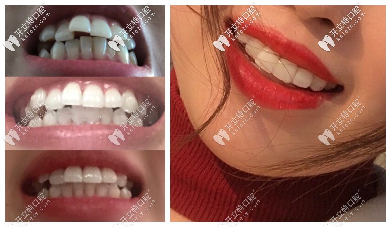 小姐姐使用笑盈隱形牙套矯正三個(gè)月的變化已經(jīng)肉眼可見