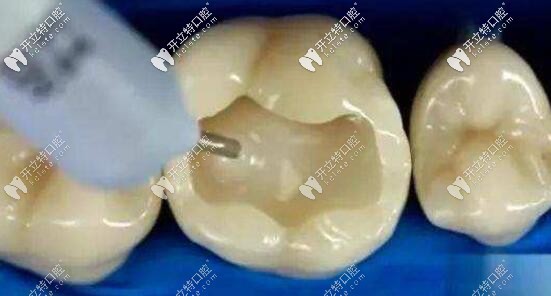 樹(shù)脂補(bǔ)牙