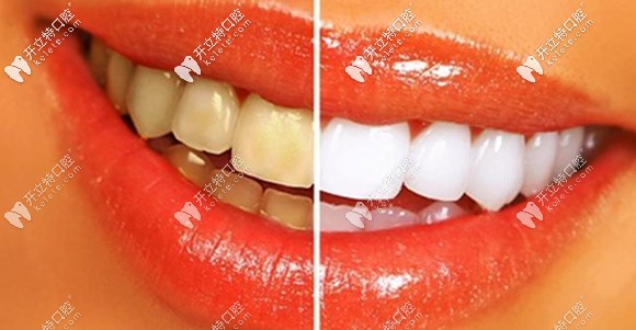 楊哲醫(yī)生介紹瓷貼面修復(fù)的特色 楊哲醫(yī)生介紹瓷貼面修復(fù)的特色