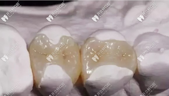 楊哲醫(yī)生對瓷嵌體修復(fù)的介紹 楊哲醫(yī)生對瓷嵌體修復(fù)的介紹