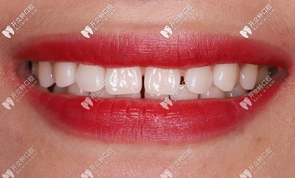 做美國beyond冷光美白后的效果圖