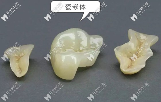 在三亞的補(bǔ)牙收費(fèi)參考價(jià)格 在三亞的補(bǔ)牙收費(fèi)參考價(jià)格