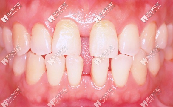 我關(guān)閉門牙縫隙前的照片 我關(guān)閉門牙縫隙前的照片