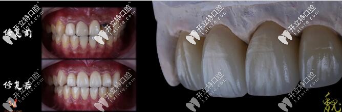 威蘭德全瓷牙前后對比