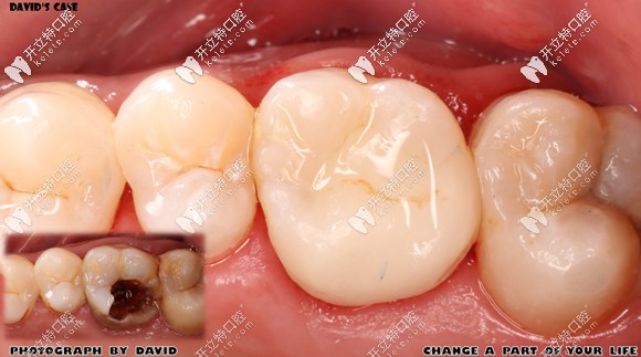 做完E-max鑄瓷嵌體修復(fù)后的效果圖 做完E-max鑄瓷嵌體修復(fù)后的效果圖