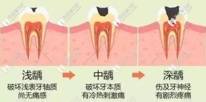 齲齒的發(fā)展過(guò)程