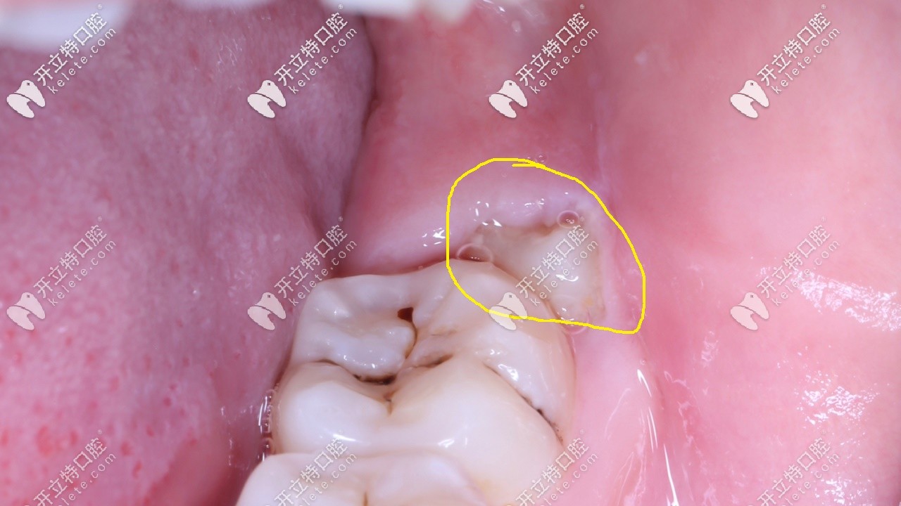 智齒一半長(zhǎng)在肉里經(jīng)常發(fā)炎疼痛,分享拔牙全過(guò)程及圖解