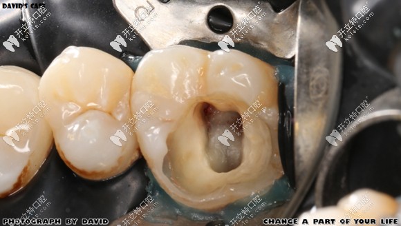 齲壞牙體去腐后的樣子 齲壞牙體去腐后的樣子