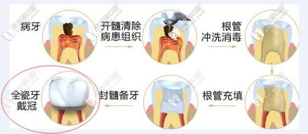 根管治療過(guò)程圖示