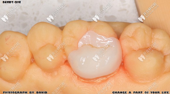 做好的e-max鑄瓷嵌體效果圖 做好的e-max鑄瓷嵌體效果圖