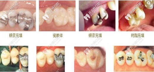 補(bǔ)牙材料種類