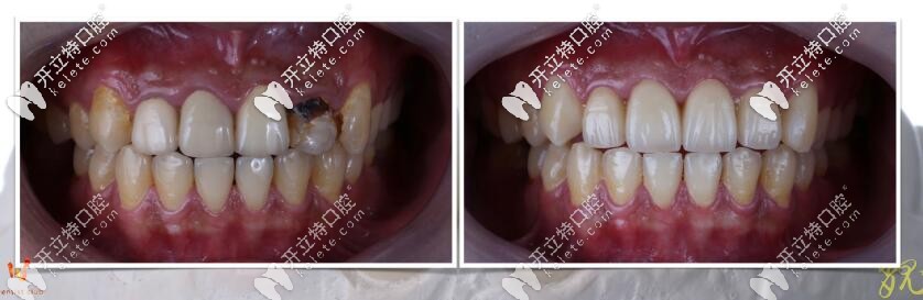 ?？谖⑿谇豢敬裳罁Q全瓷牙真人案例