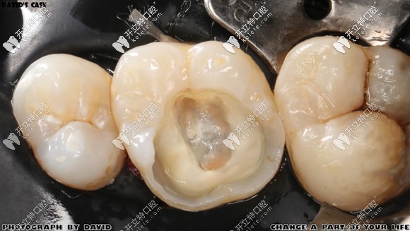 重度齲齒做根管治療后的即刻照 重度齲齒做根管治療后的即刻照