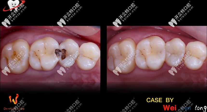 ?？谖⑿谇粯?shù)脂補(bǔ)牙真人案例