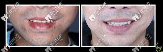 ?？谖⑿ρ揽仆m德全瓷牙真人案例