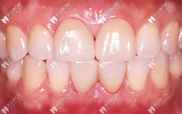 門牙剛做完瓷貼片后的效果 門牙剛做完瓷貼片后的效果
