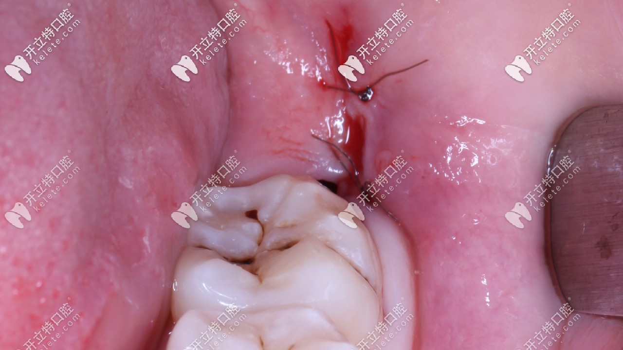 ?？谖⑿谇会t(yī)院拔智齒案例