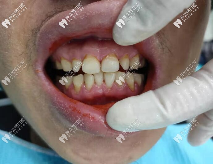 海南?？谖⑿谇粺煗n牙洗牙真人案 