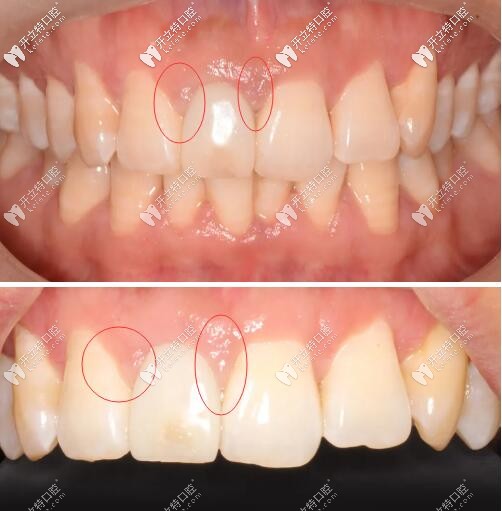 過渡義齒修復(fù)齦乳頭變化