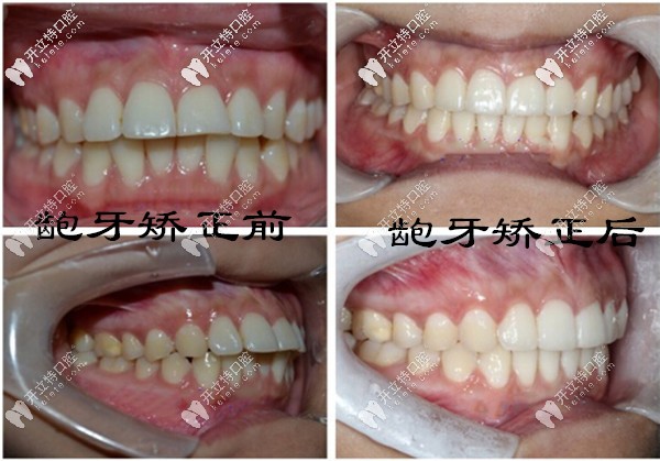 齙牙在?？诙c口腔做矯正前后對比照片