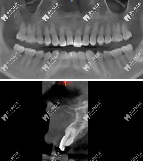 門牙磕斷傷及牙根影像學(xué)檢查