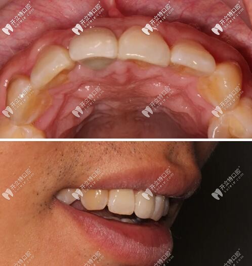 門牙磕傷瑞士iti種牙修復(fù)1年后