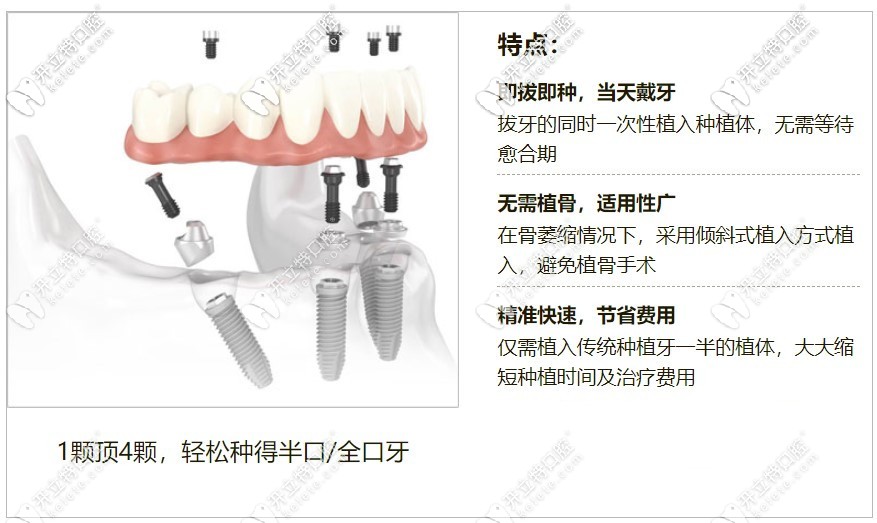 牙管家特色種植技術(shù)當(dāng)日用種植牙體系特點(diǎn)