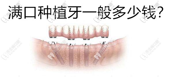 才二十歲就烤瓷了17顆牙,想換滿口牙種植一般多少錢？