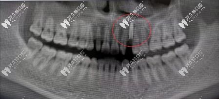 案例:法國安卓健Axiom?2.8mm型號種植體修復缺失切牙虎牙超贊