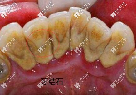 潔牙98起,國產(chǎn)全瓷牙888起,安康私人連鎖口腔收費價格表盤點