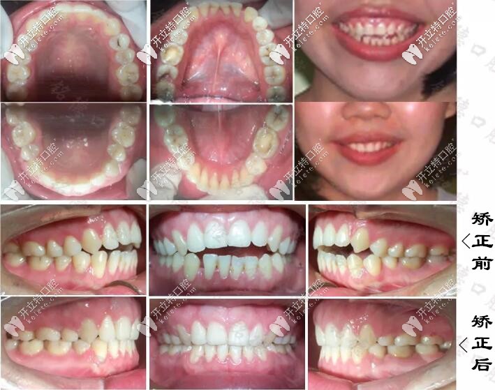 深圳銘德口腔牙齒開頜矯正案例