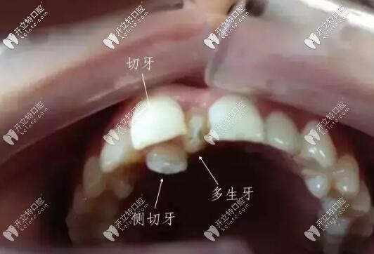 多生牙導致牙列擁擠