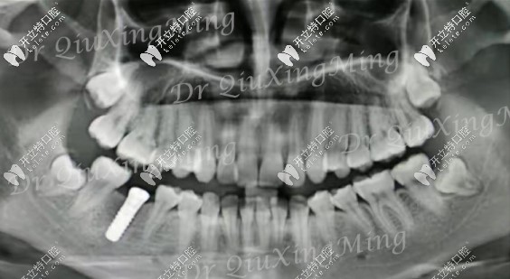 第1磨牙缺失種植后的圖片