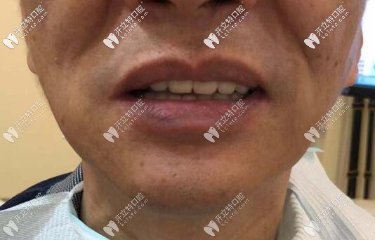 老爸在福州維樂口腔做全口種植牙后的照片