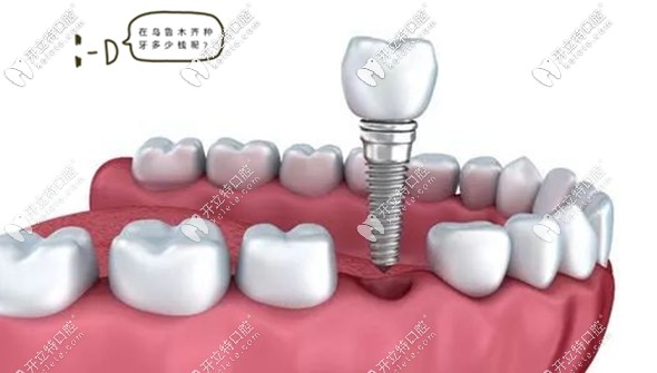 烏魯木齊牙科資訊:做種植牙只關(guān)注價格是誤區(qū),這點更重要...