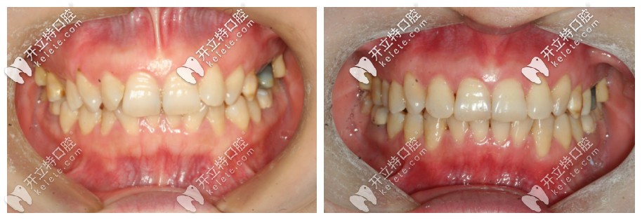 深覆合矯正前后效果圖 深覆合矯正前后效果圖