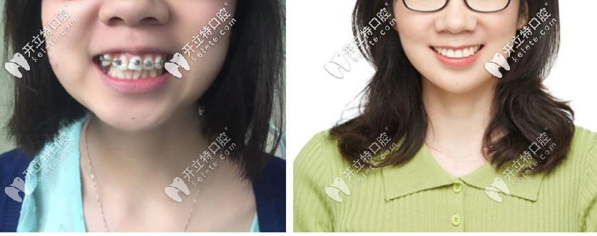 爆我箍牙前后臉型對(duì)比照?qǐng)D，你還覺(jué)得門牙外凸沒(méi)必要矯正