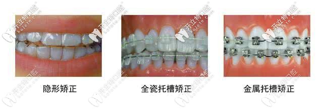 牙齒矯正種類 牙齒矯正種類