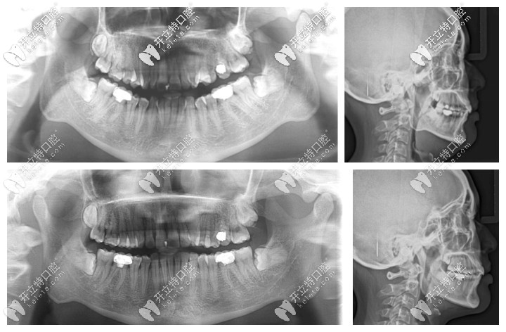 深覆合矯正前后的CT片 深覆合矯正前后的CT片
