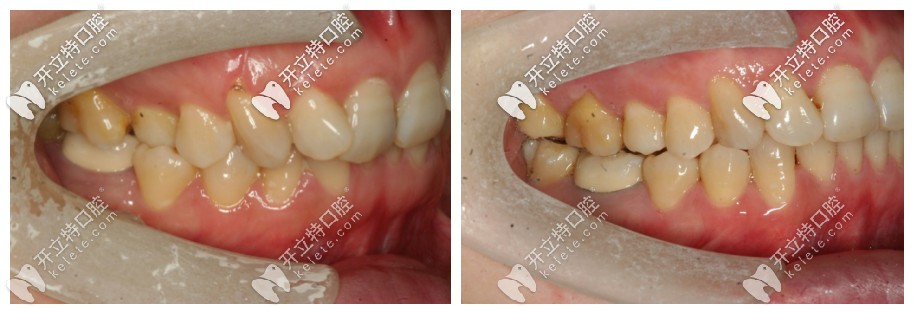 從側面照更能看出來牙齒原本的問題 從側面照更能看出來牙齒原本的問題
