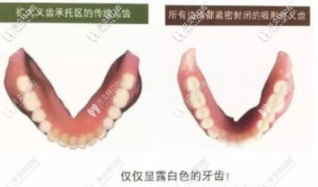 吸附性義齒與傳統(tǒng)義齒區(qū)別