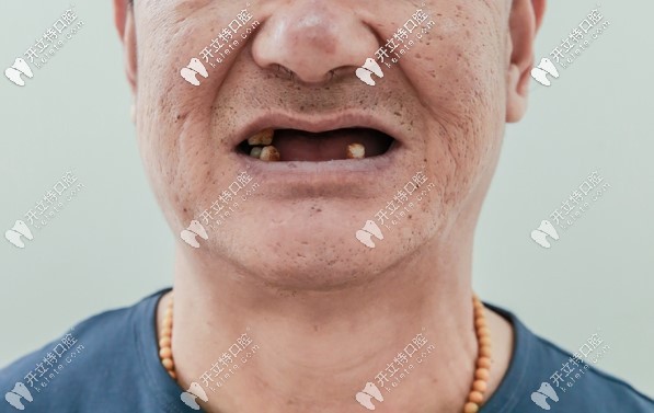 去北京海德堡聯(lián)合口腔種牙前趙叔的口腔狀況