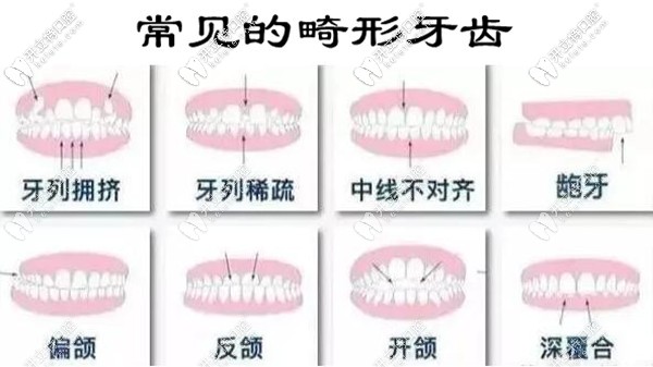 常見(jiàn)的畸形牙齒